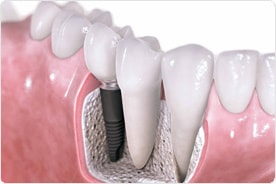 dental implants vijayawada
